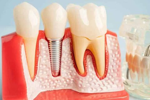 IMPLANTOLOGÍA DENTAL